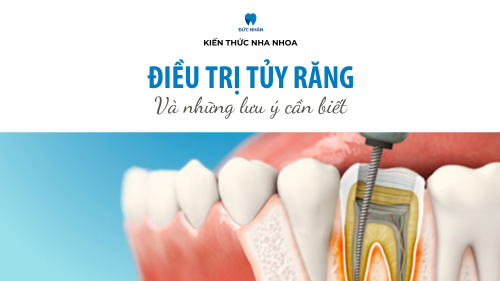 Điều trị tủy răng là gì, có đau không và dấu hiệu phát hiện viêm tủy